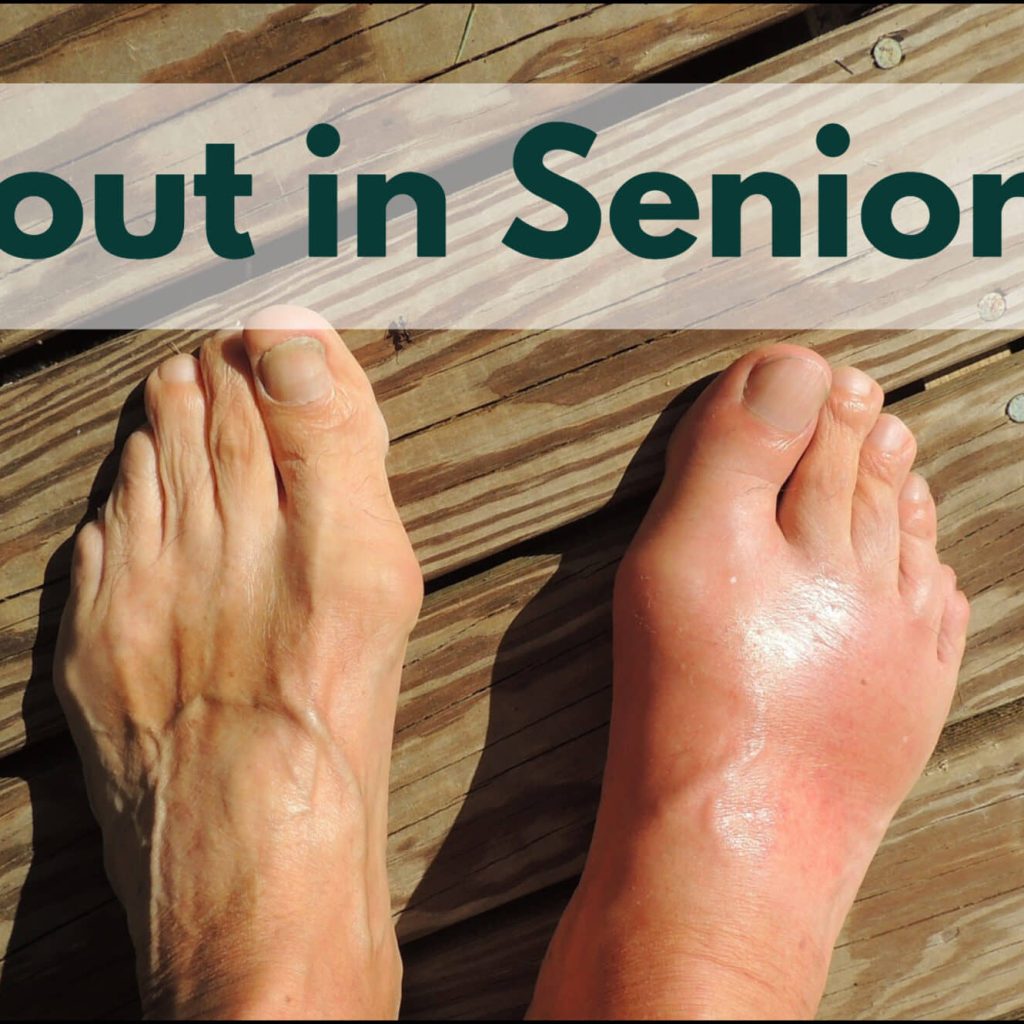Gout in Seniors: Recognizing the Warning Signs and Addressing Complications