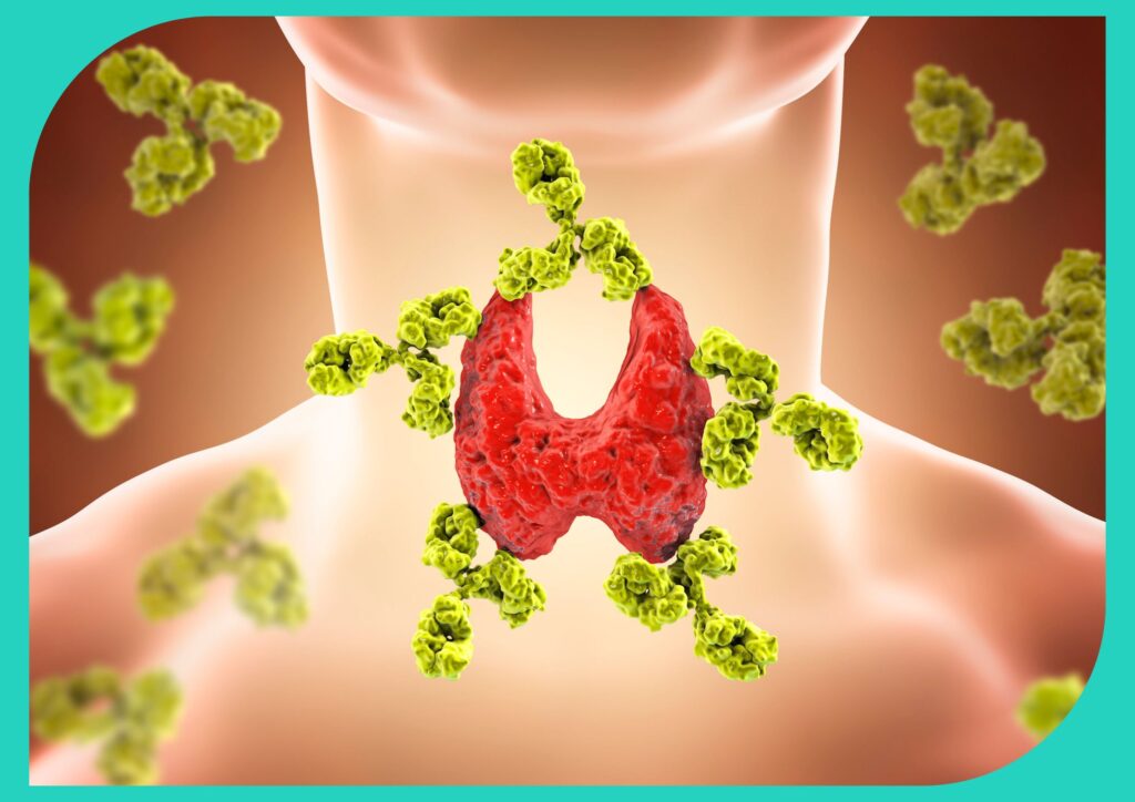 An illustration of Hashimoto's disease