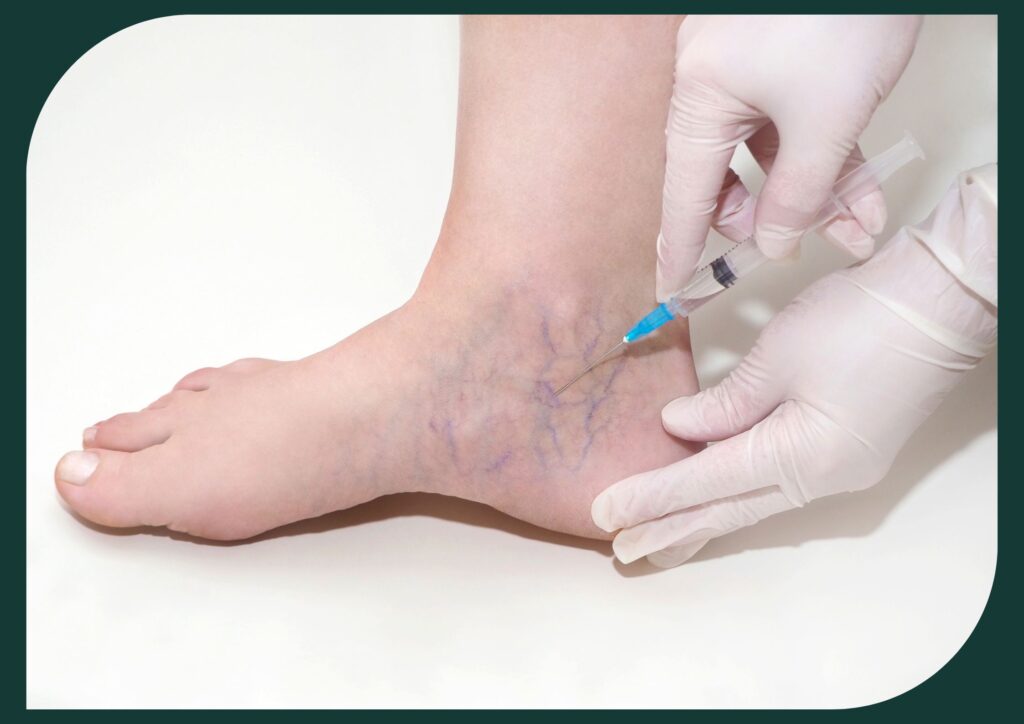 Sclerotherapy treats varicose veins by redirecting blood flow with injected solution, collapsing affected veins.