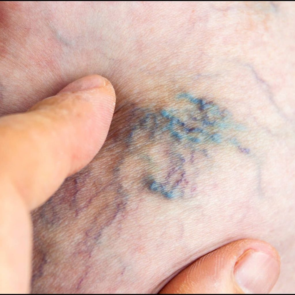 Seniors' Varicose Veins: A Common Problem with Surprising Solutions