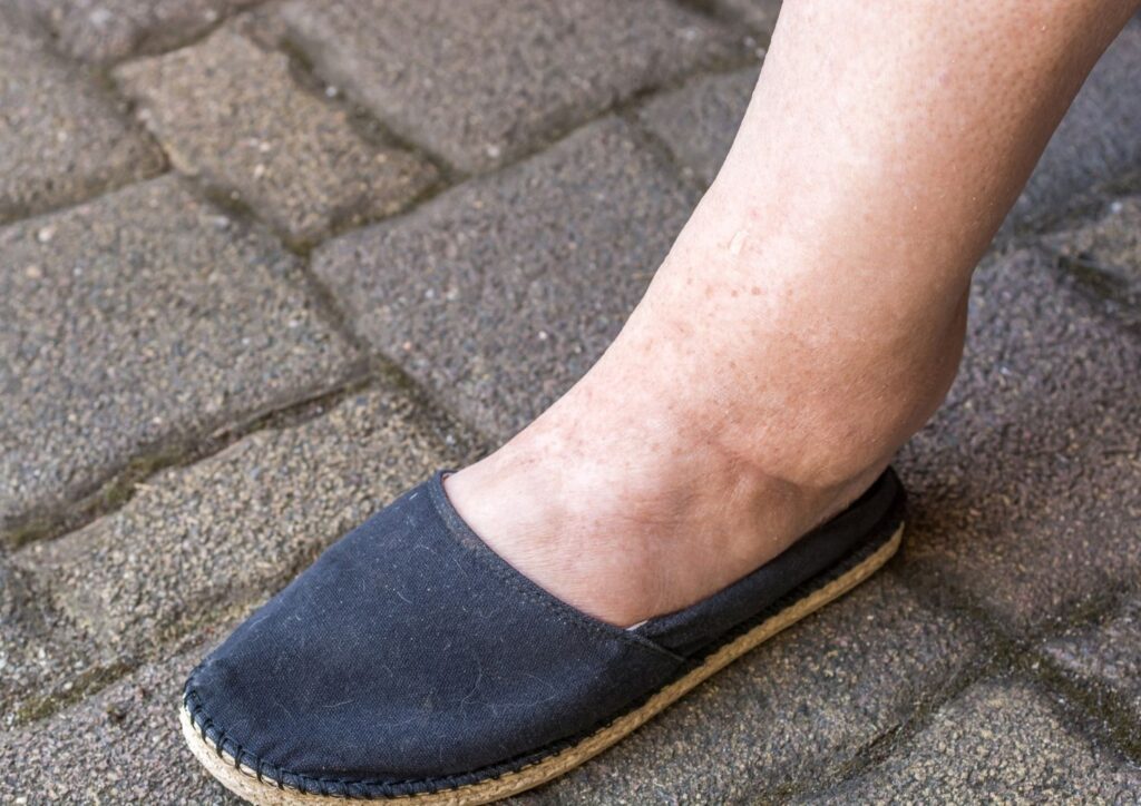 Swollen leg of a woman with water retention