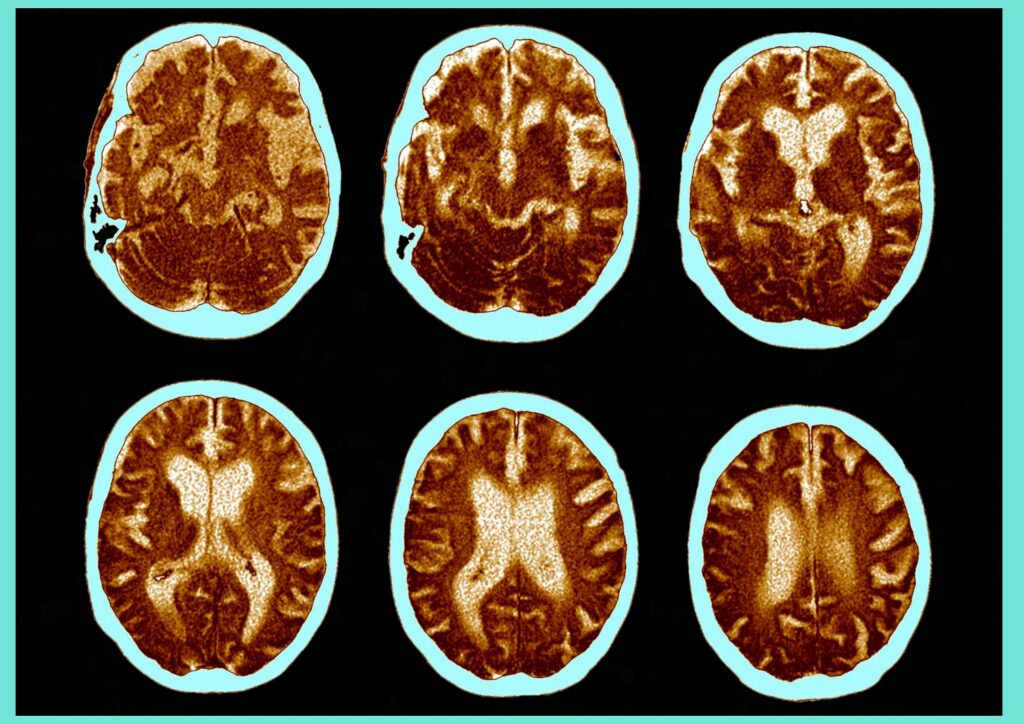 Sensory stimulation is important in therapy for Alzheimer's patients due to declining cognitive and physical abilities.