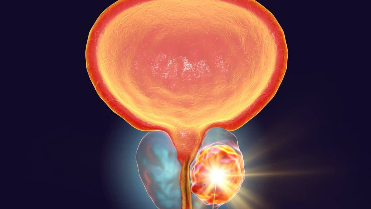 an image representation of an enlarged prostate