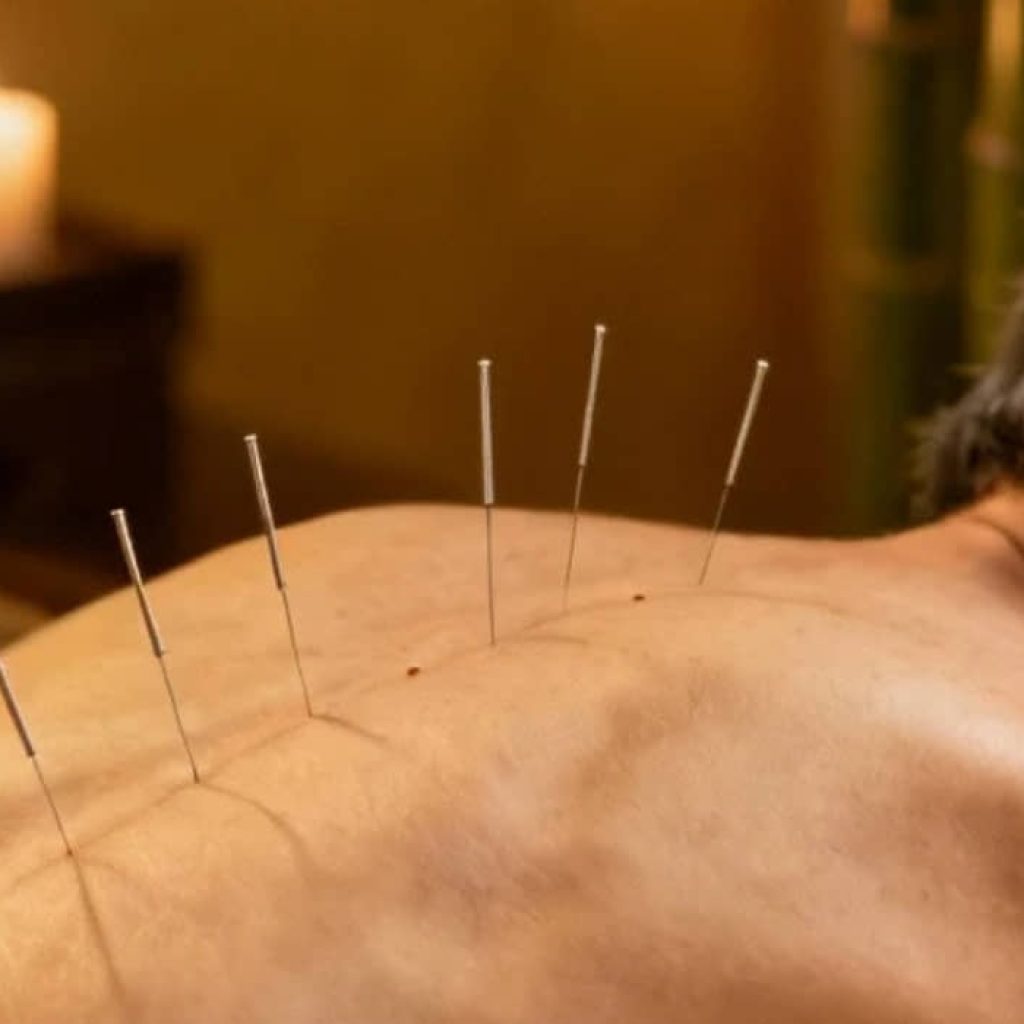 Needles of Hope: Acupuncture Shows Staying Power for Aging Backs